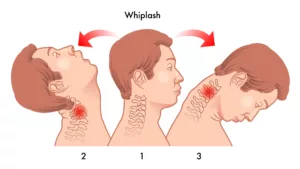 A Medical Illustration Shows A Sequence Of Neck Movements Leading To Whiplash, With Red Pain Indicators Highlighting Cervical Spine Trauma—Illustrating The Type Of Soft Tissue Damage An Arlington Whiplash Injury Lawyer Can Help Clients Seek Compensation For.